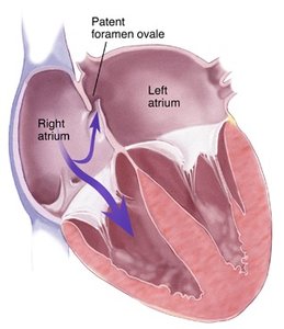 Patent foramen ovale