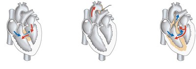 Congenital heart defects: septal defect, coarctation, Tetralogy of Fallot
