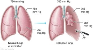 Lung collapse due to increased intrapleural pressure