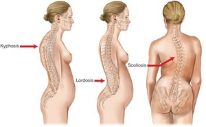 Spinal disfigurements: kyphosis, lordosis, scoliosis