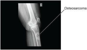 X-ray of osteosarcoma below the knee joint