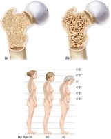 Osteoporosis: normal vs. osteoporotic bone and spinal curvature