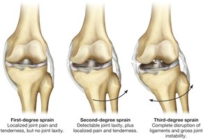 Degrees of sprain: first, second, third
