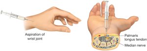 Arthrocentesis: aspiration of wrist joint