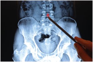 Arthrogram: X-ray showing inflammation of intervertebral disc
