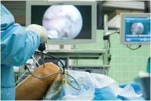 Arthroscopic knee surgery
