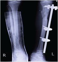 Fracture reduction: X-ray of closed and open reduction