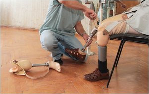 Orthotist adjusting a prosthetic device