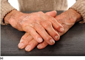 Osteoarthritis in finger joints