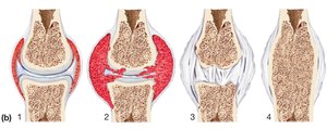 Progression of rheumatoid arthritis