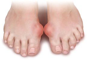 Gout affecting the big toe