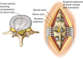 Herniated disk and surgical exposure