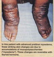 Myxedema