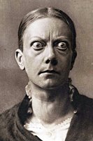 Goiter and cretinism