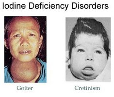 Cretinism clinical image