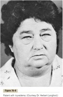 Myxedema facial features