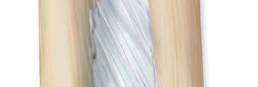 Bone fracture illustration