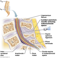 Lumbar puncture and cauda equina