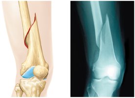 Types of fractures (transverse, spiral)