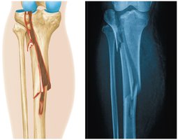 Types of fractures (greenstick, epiphyseal plate)