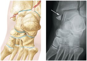 Types of fractures (additional examples)