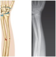 Types of fractures (additional examples)