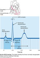 Ventricular fibrillation ECG tracing