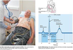 Recording an ECG and the typical ECG tracing