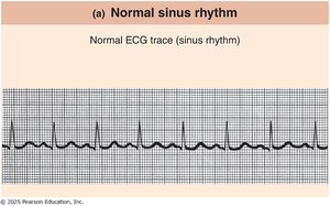 Normal sinus rhythm ECG tracing