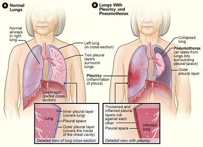 Normal lungs vs. lungs with pleurisy and pneumothorax