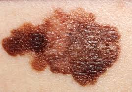 Clinical image of a pigmented, irregular skin lesion