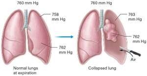 Pneumothorax and lung collapse