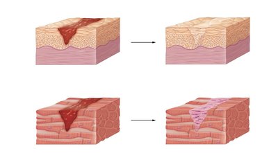 Regeneration and fibrosis in tissue repair