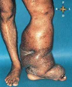 Elephantiasis of limb