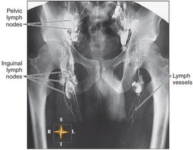 Lymphangiogram showing pelvic and inguinal lymph nodes