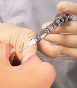 Administration of local anesthetic in dental procedure.