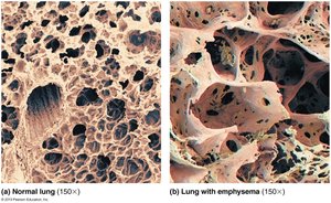 Tissue changes in emphysema