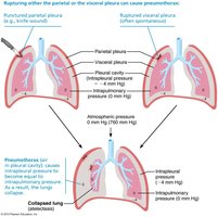 Pneumothorax