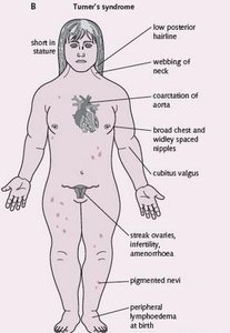 Turner syndrome clinical features