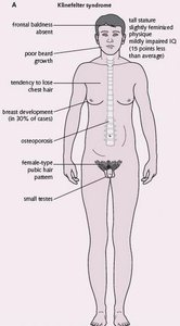 Klinefelter syndrome clinical features