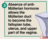 Absence of AMH allows Müllerian duct to become female structures