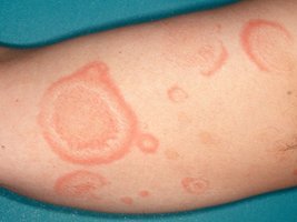 Example of erythema on skin