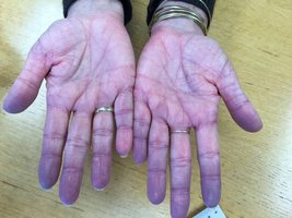 Cyanosis in hands due to low oxygen