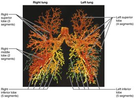 Cast of the bronchial tree
