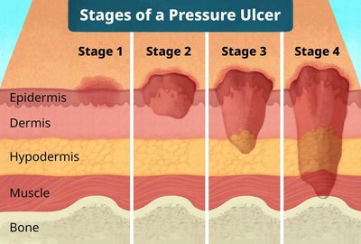 Stages of a pressure ulcer