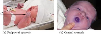 Peripheral and central cyanosis in infants