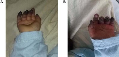 Bilateral cyanosis of the hands