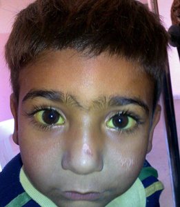 Jaundice in a child