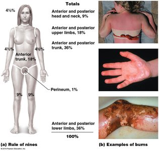 Rule of nines and examples of burns