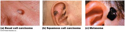 Types of skin cancer: basal cell carcinoma, squamous cell carcinoma, melanoma